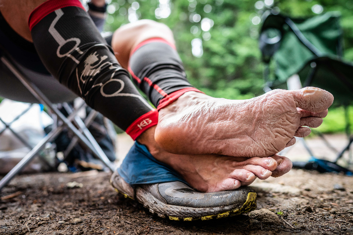 Tired, blistered feet